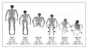 Osteogenesis Imperfecta Types