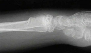 What is the correct treatment for tarus (buckle ) fractures of distal radius in children